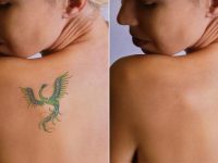 consejos de eliminacion de tatuajes